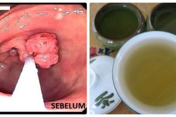 Chữa ung thư dạ dày bằng lá đu đủ