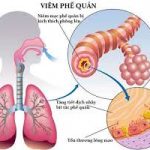 Một số bài thuốc dân gian trị viêm phế quản có hiệu quả cao