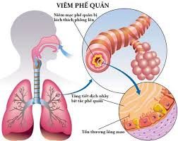 Một số bài thuốc dân gian trị viêm phế quản có hiệu quả cao